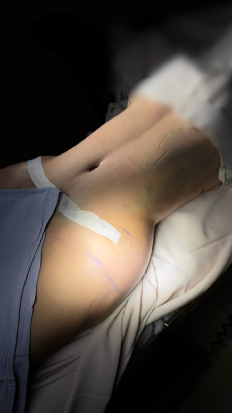 Abdominoplastia - Abdominoplastia & Remodelación de Contorno (Después • Perfil)