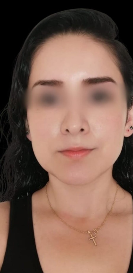 Bichectomía - Adelgazamiento Facial & Proyección de Pómulos (Antes)