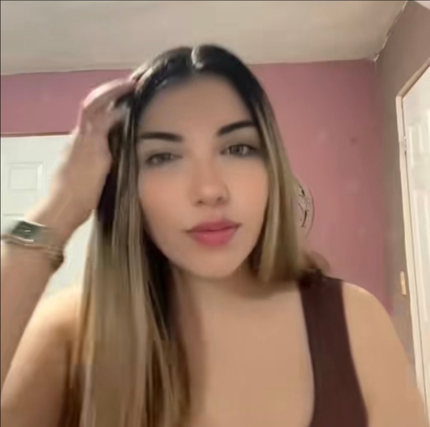 Bichectomía - Perfilado del Tercio Medio Facial (Antes)