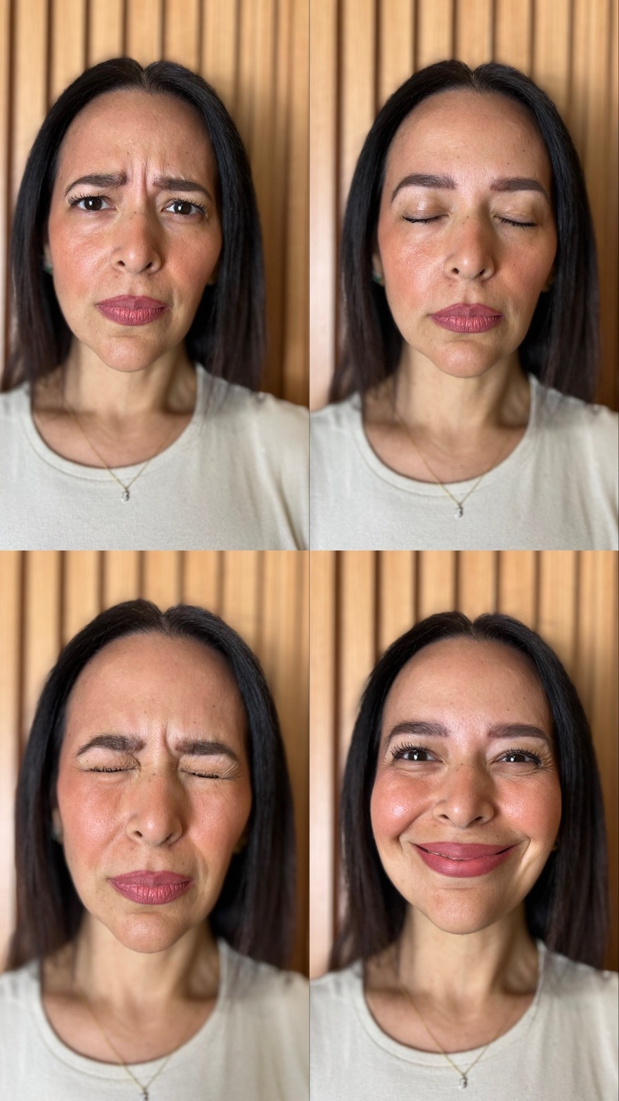 Botox Cosmético - Rejuvenecimiento del Tercio Superior con Toxina Botulínica (Antes)