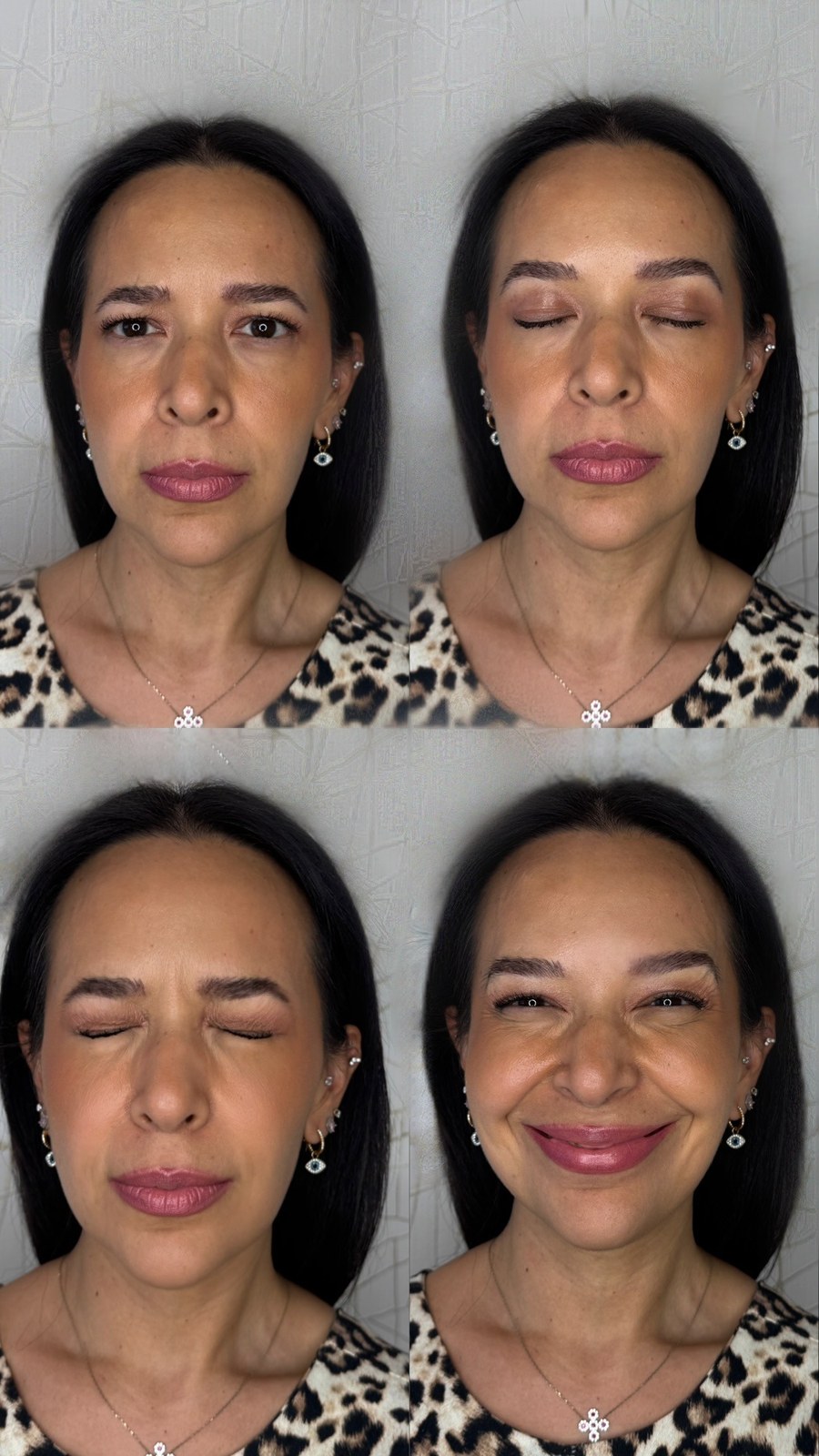 Botox Cosmético - Rejuvenecimiento del Tercio Superior con Toxina Botulínica (Después)
