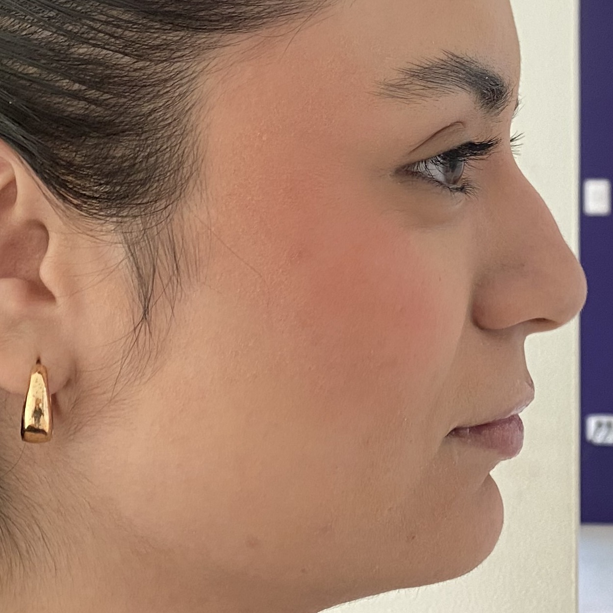 Relleno de Labios - Perfilado & Volumen Labial con Ácido Hialurónico (Antes)