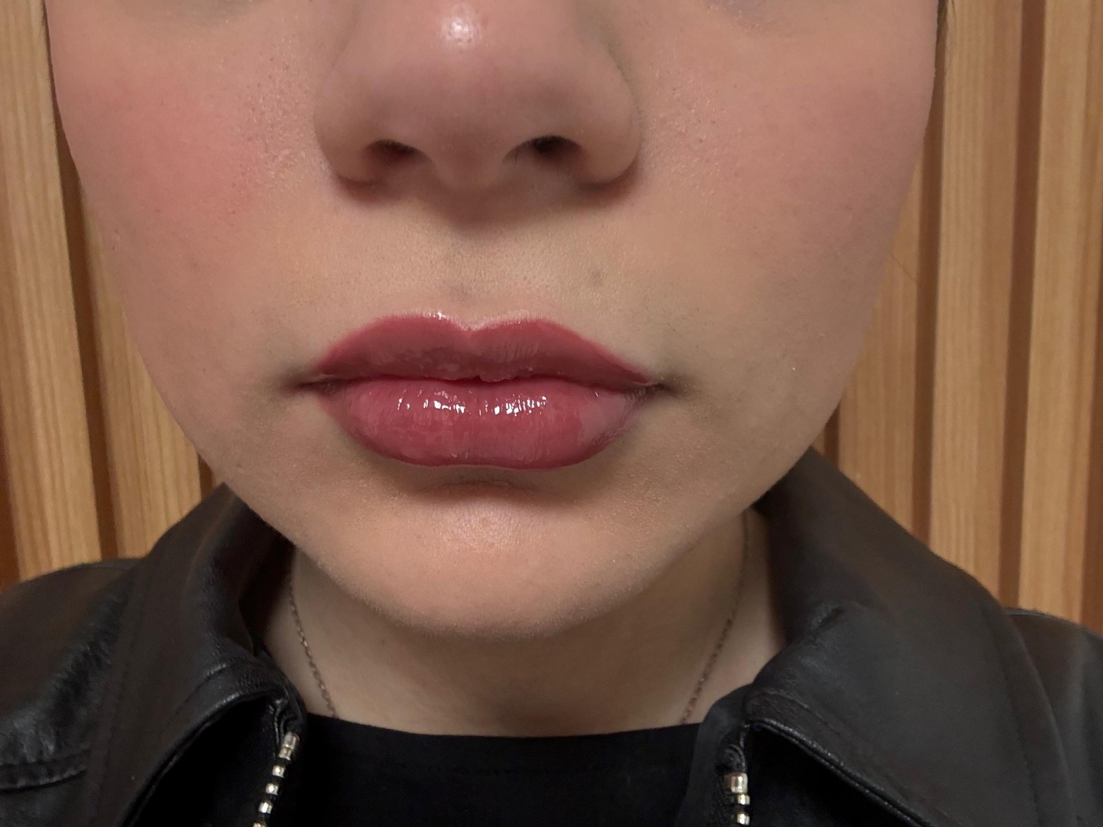 Relleno de Labios - Perfilado & Volumen Labial con Ácido Hialurónico (Después • Vista Frontal)