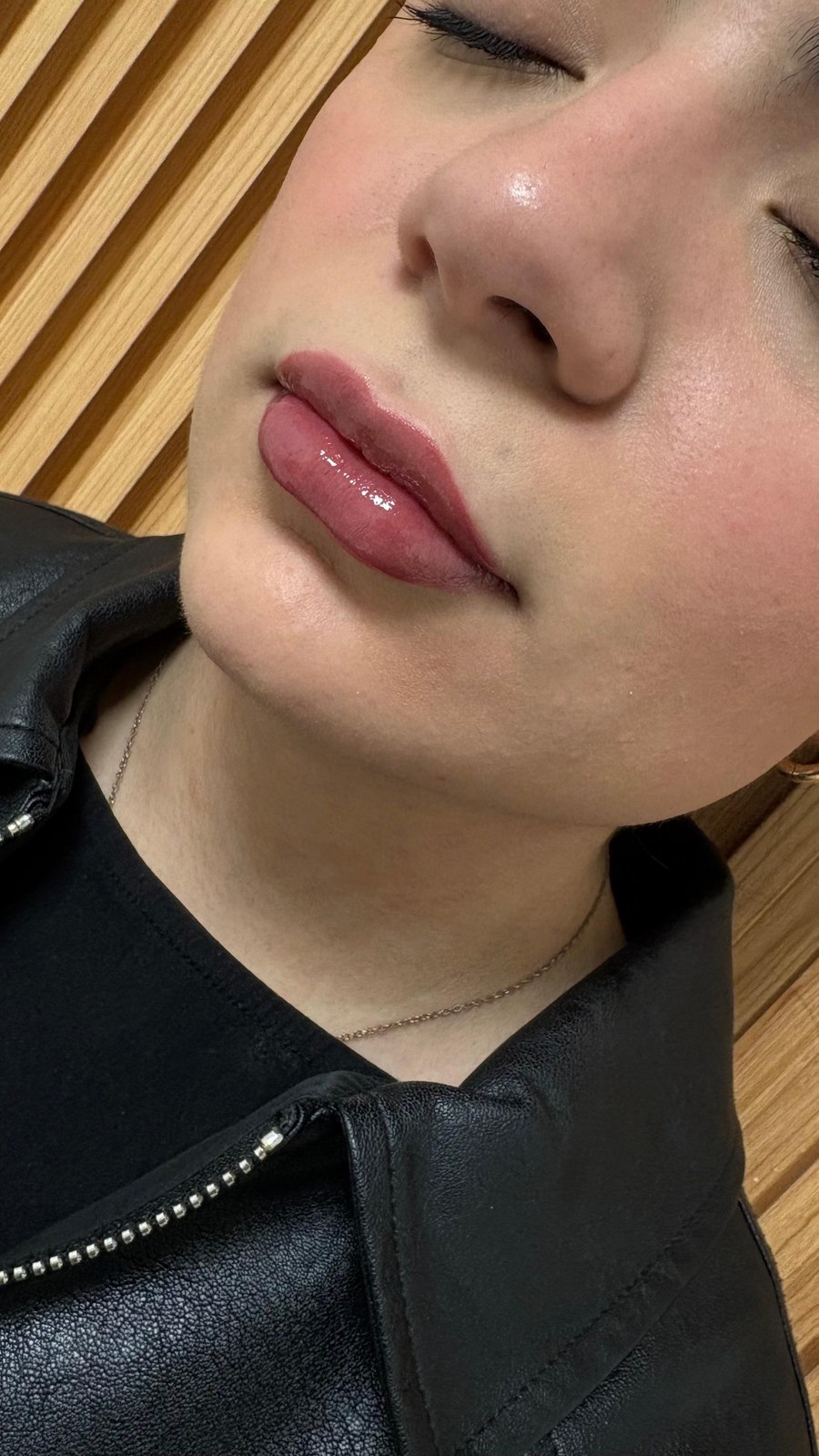 Relleno de Labios - Definición del Arco de Cupido & Proyección Lateral (Después • Simetría)