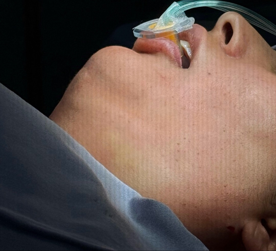LipoPapada - Definición del Ángulo Cervicomandibular (Antes)