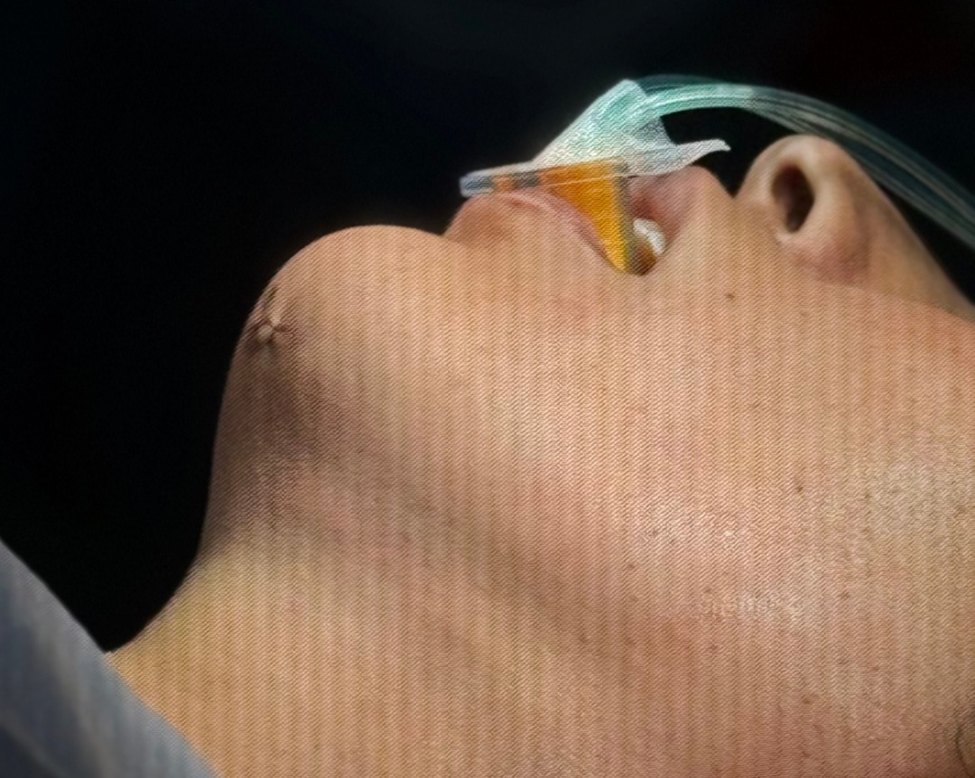 LipoPapada - Definición del Ángulo Cervicomandibular (Después)
