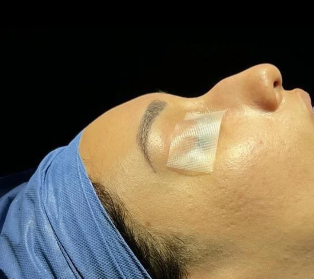 Rinoplastia Estructural - Rinoplastia Estructural & Perfiloplastia (Antes)