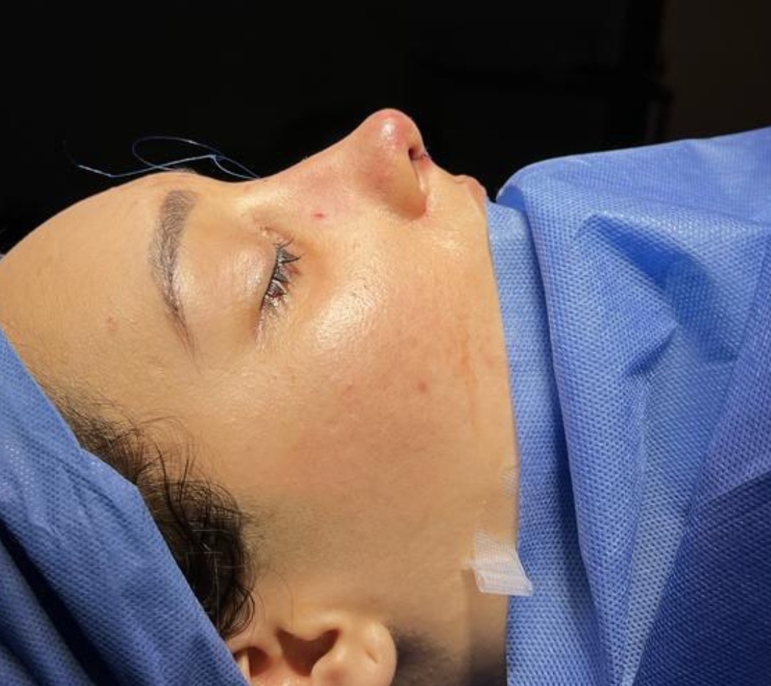 Rinoplastia Estructural - Rinoplastia Estructural & Perfiloplastia (Después)