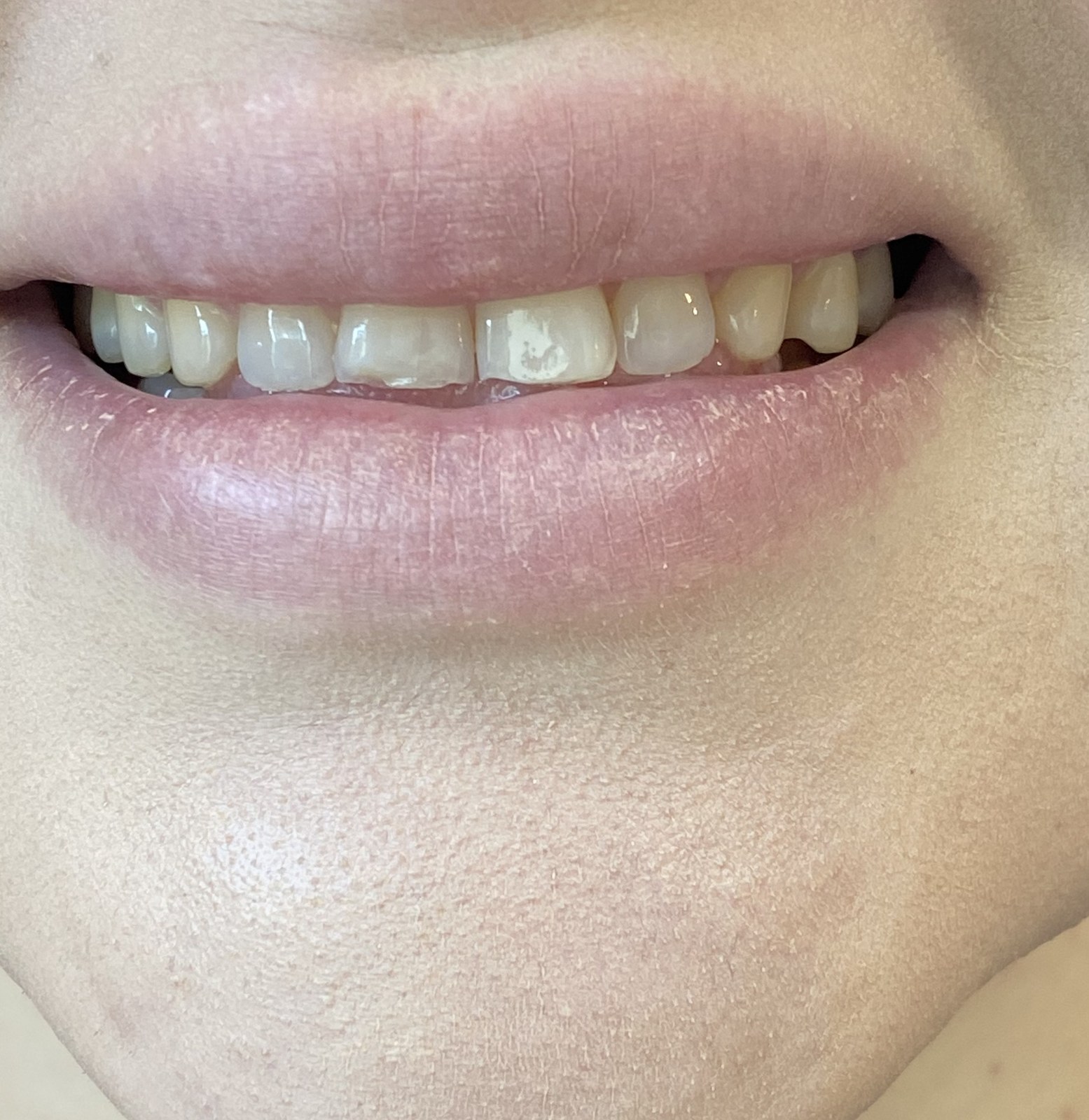 Diseño de Sonrisa - Diseño de Sonrisa con Láminas de Composite (Antes)