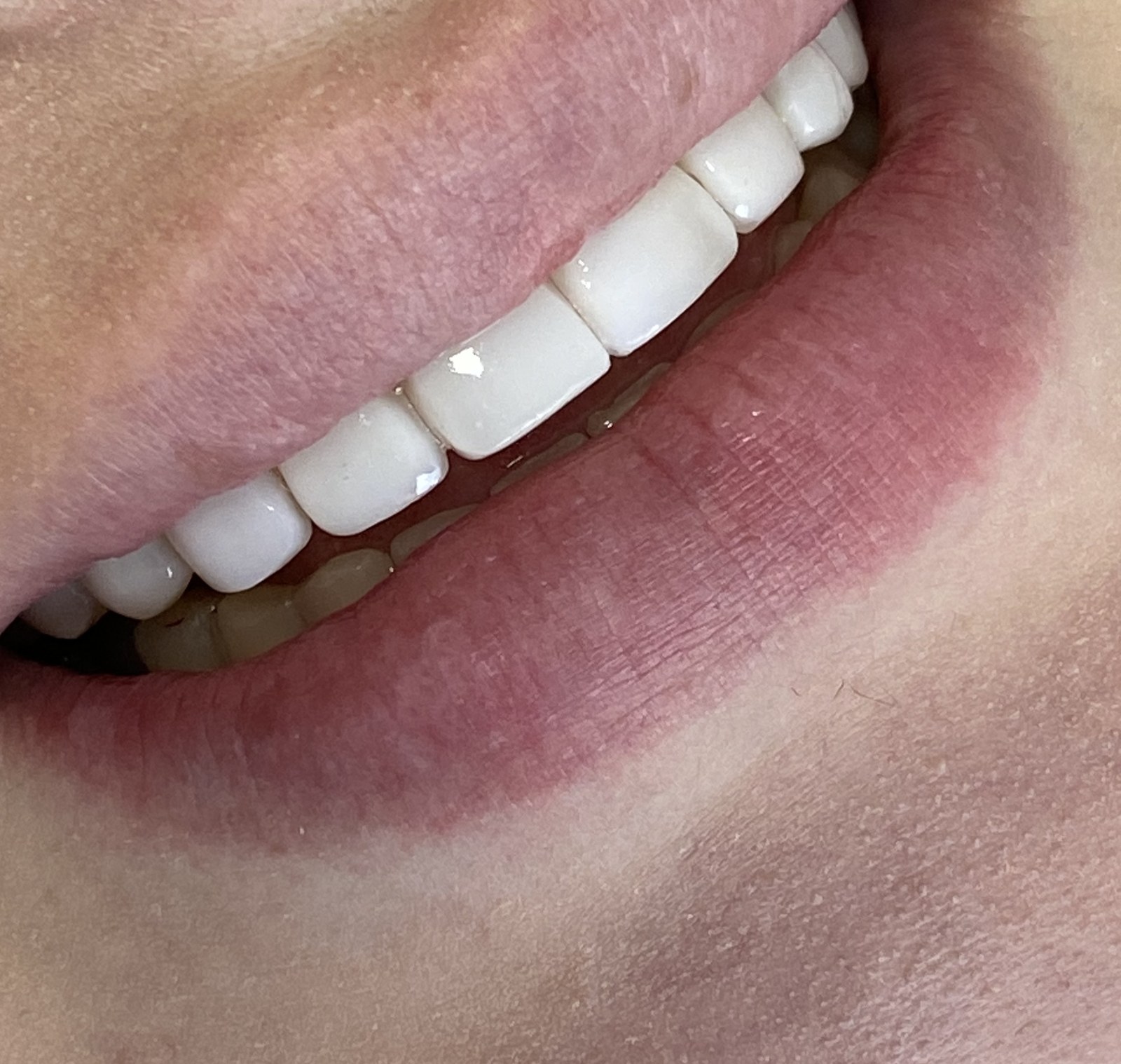 Diseño de Sonrisa - Diseño de Sonrisa con Láminas de Composite (Después)