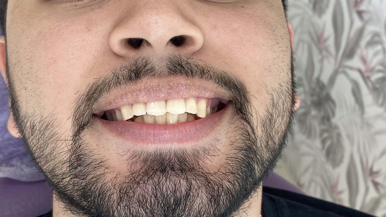 Diseño de Sonrisa - Armonización de Arcada & Proporción Dental (Antes)