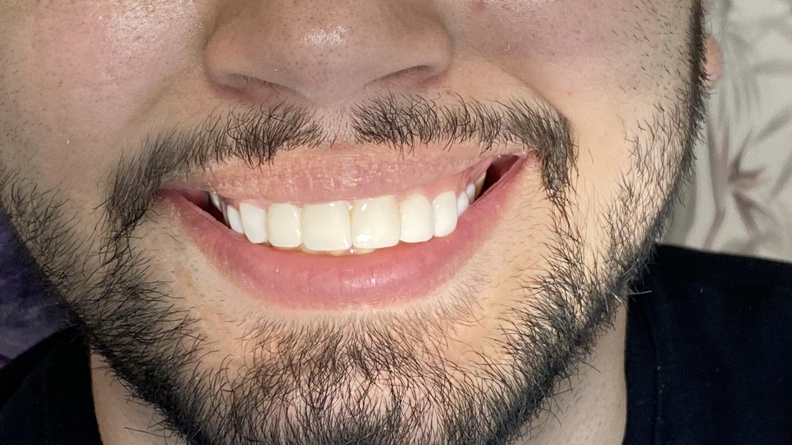Diseño de Sonrisa - Armonización de Arcada & Proporción Dental (Después)