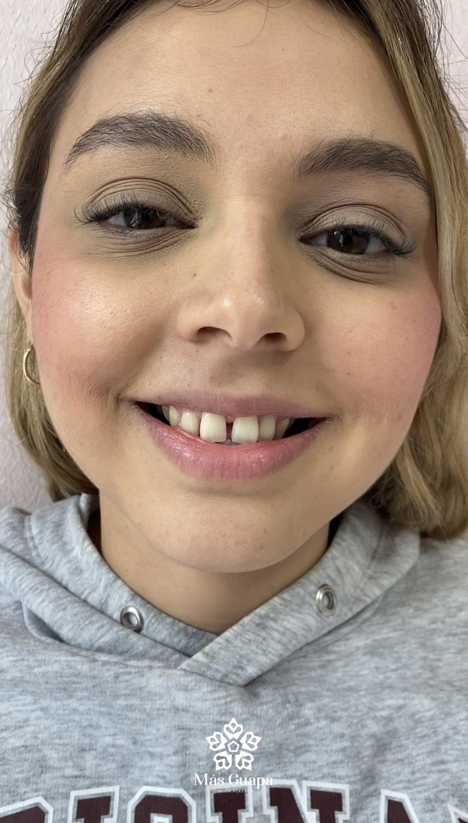 Diseño de Sonrisa - Cierre de Diastema Central & Armonía Facial (Antes)